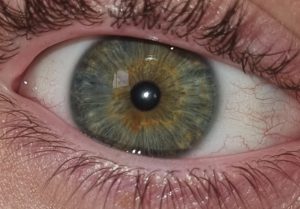 Heterochromia Gray, Green eye color
