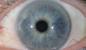 1a Pale blue eyes color